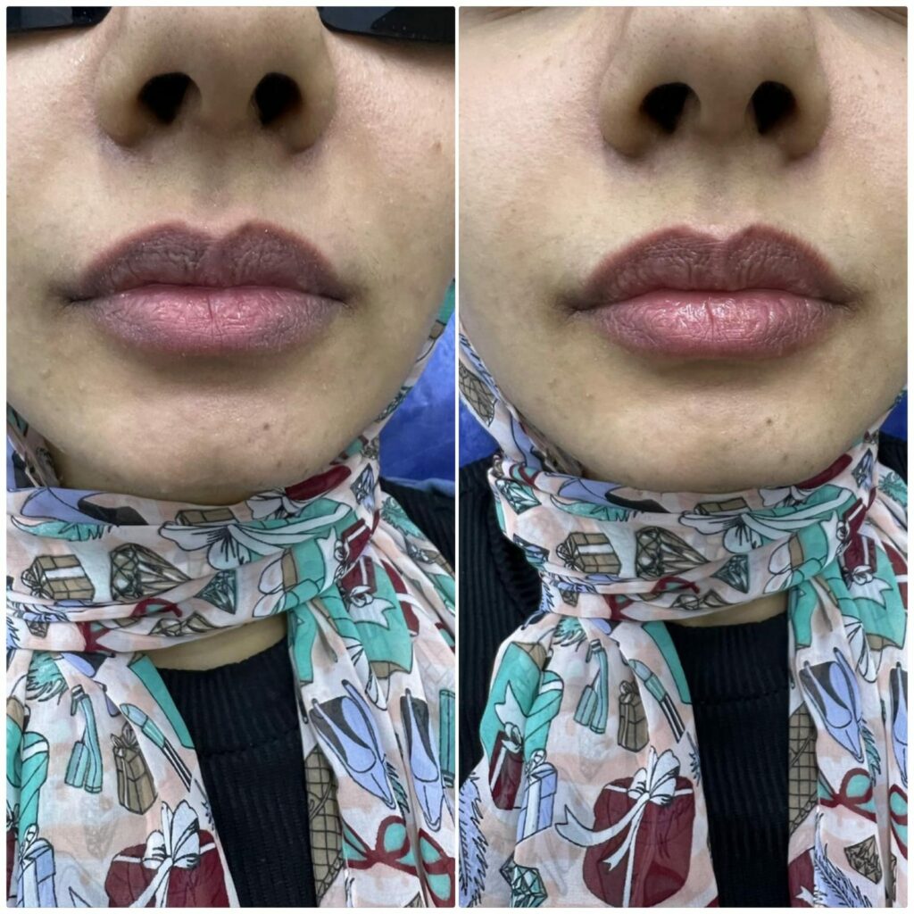 Lip filler injections for enlargement